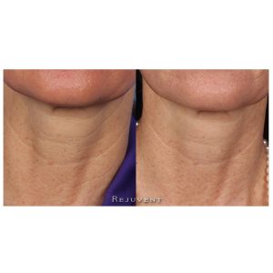 Revision Nectifirm Before and After results