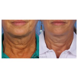 Revision Nectifirm Before and After results