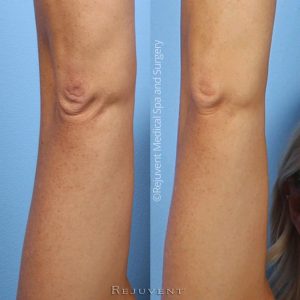 Rejuvent Skincare Closeup of elbow improvement after Bodifirm lotion