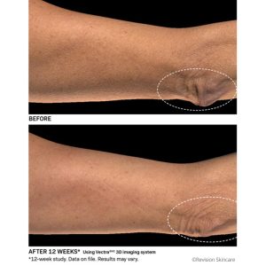 Closeup of elbow improvement after Bodifirm lotion
