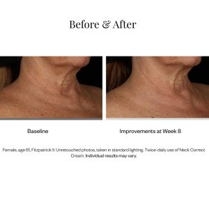 SkinMedica Neck Correct Cream results 2