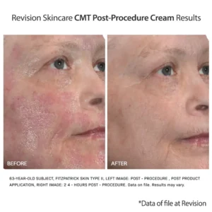 Revision Skincare CMT Post-Procedure Cream results show less redness and irritation on older skin