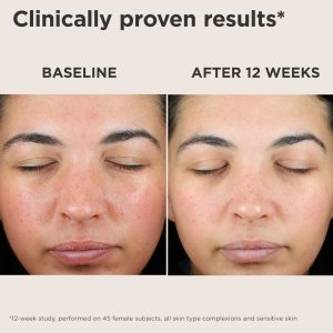 EltaMD UV Skin Recovery SPF 50 results show less redness