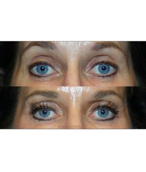 Latisse grows eyelashes and brows