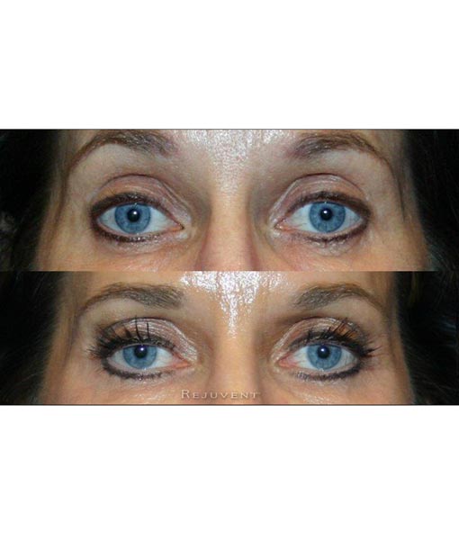 Latisse grows eyelashes and brows