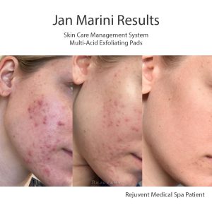 Jan Marini Rejuvent Patient Results