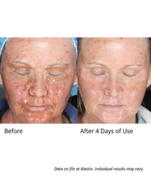 Alastin Skin Nectar results after 4 days of use