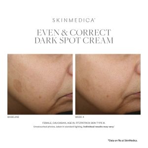 SkinMedica Even and Correct Dark Spot Cream Results on white skin customer