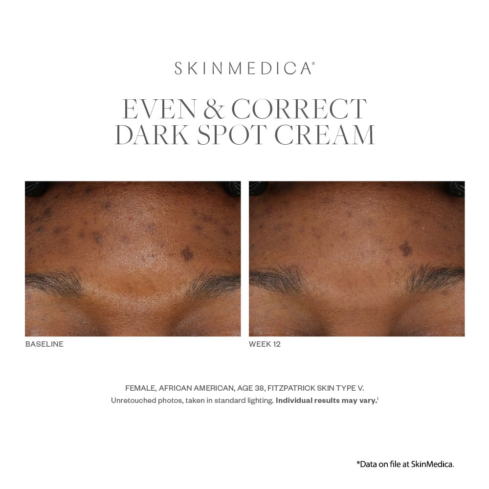 SkinMedica Even and Correct Advanced Brightening Serum results