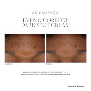 SkinMedica Even and Correct Dark Spot Cream Results on dark skin customer