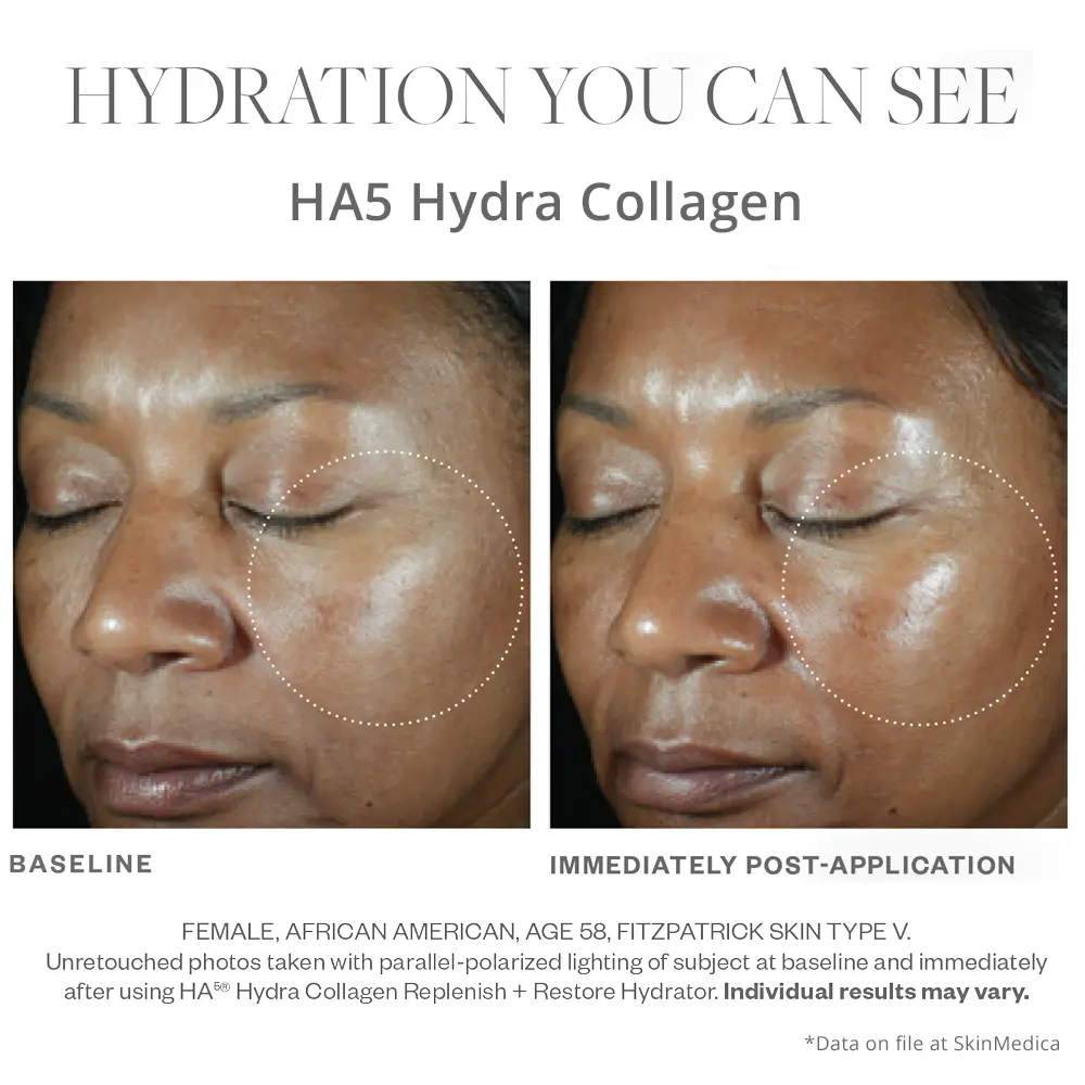 SkinMedica HA5 Hydra Collagen before and after results right after use