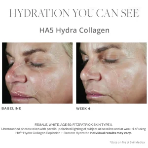 SkinMedica HA5 Hydra Collagen before and after results on older woman
