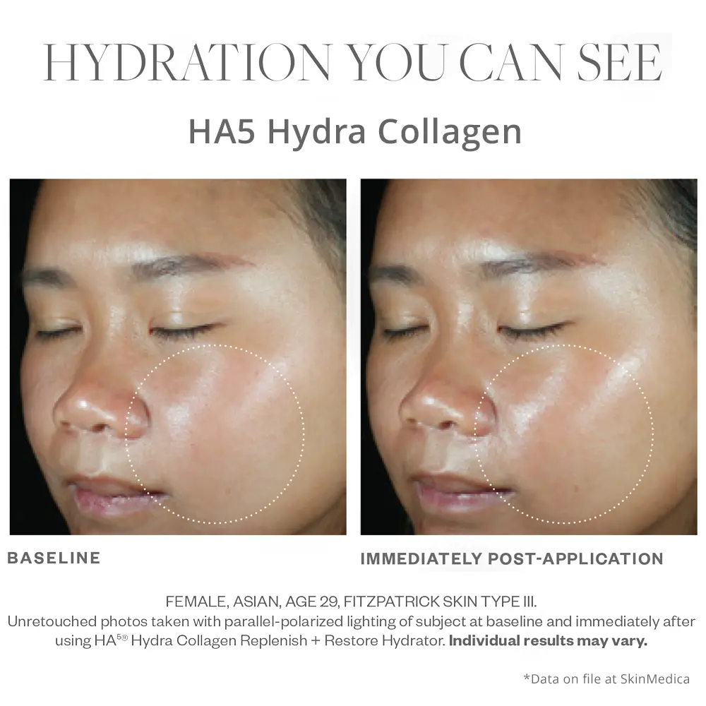 SkinMedica HA5 Hydra Collagen before and after results right after use