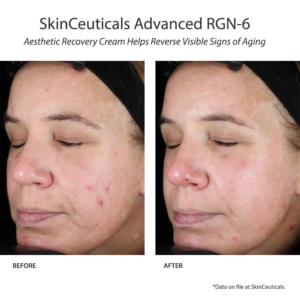 SkinCeuticals Advanced RGN-6 before and after shows less pigmentation